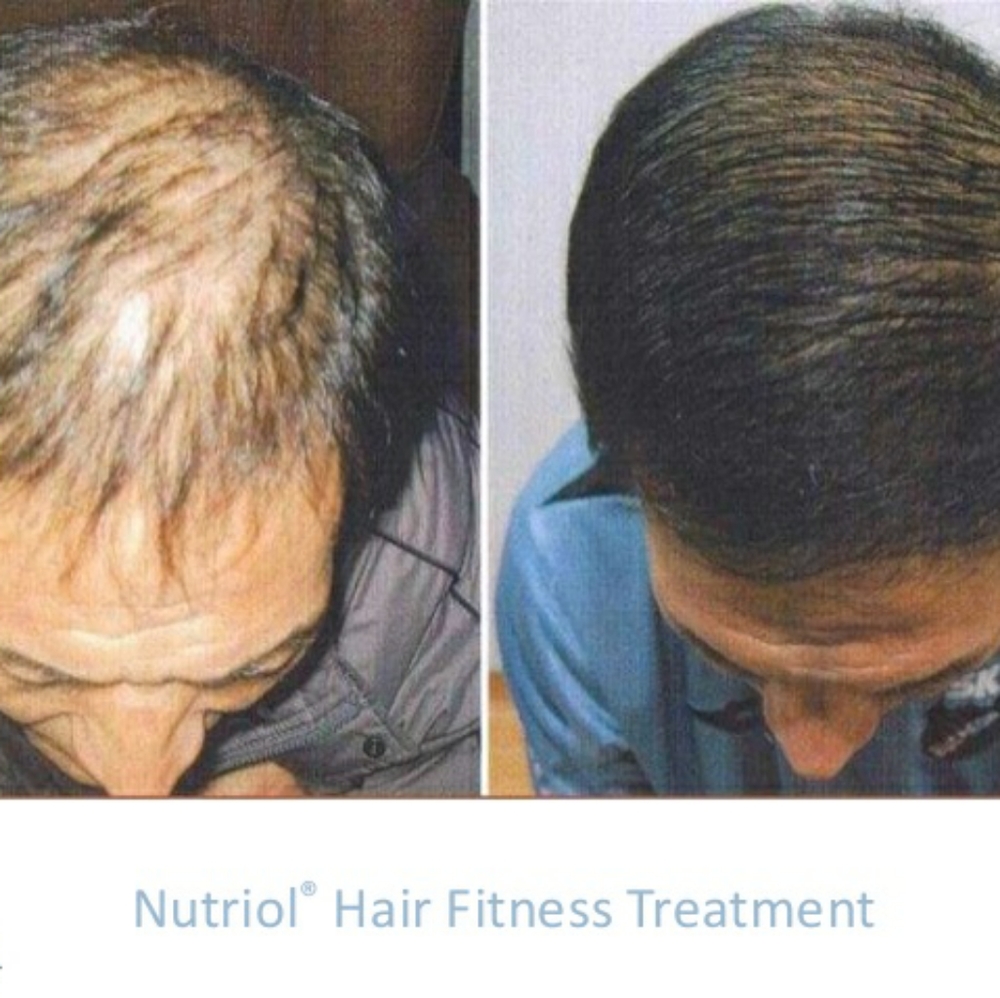 PRE-ORDER ONLY Scalp & Hair System